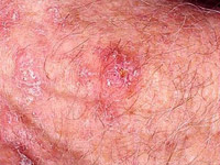 keratosis